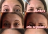 Prevenção de Rugas- Toxina Botulínica - Botox.